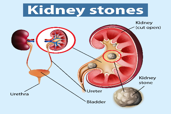 KIDNEY STONE PACKAGE